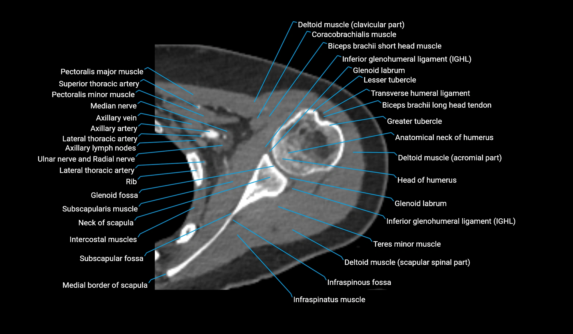 CT upper arm axial  cross sectional anatomy labelled radiology image -00102.webp